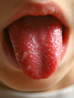 Скарлатина у детей фото симптомы и лечение