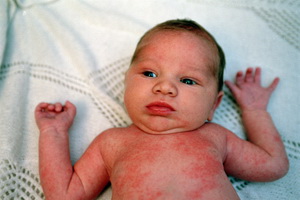 Инфекционные и неинфекционные заболевания кожи новорожденных