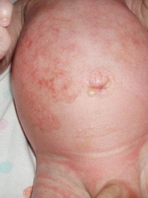 Уход при заболеваниях кожи у новорожденных