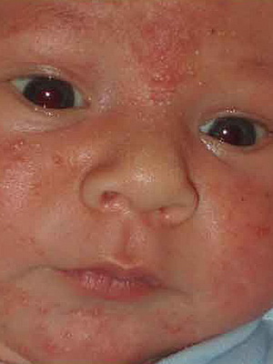 Уход при заболеваниях кожи у новорожденных thumbnail