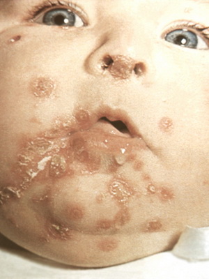 Уход при заболеваниях кожи у новорожденных