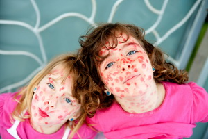 Коревая краснуха у детей: симптомы, последствия и лечение