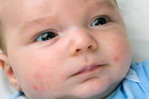 Детская пищевая аллергия – коварный враг