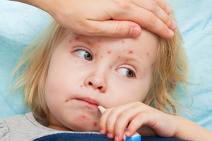 Корь у детей: симптомы, последствия и лечение Корь у детей: симптомы, последствия и лечение